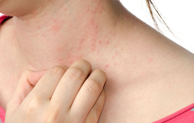 Atopic dermatitis (AD) is a form of eczema
