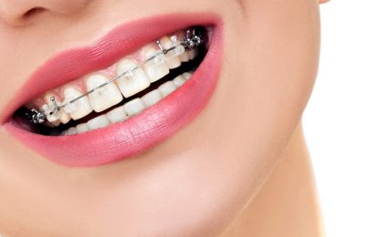 Few Benefits Of Invisible Braces That Can Change Your Life