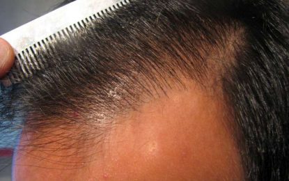 Can Doctors Use Body Hair to Complete an FUE Hair Transplant?