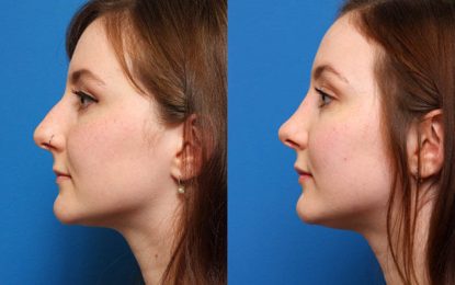Choose Rhinoplasty for a Better-Looking Nose