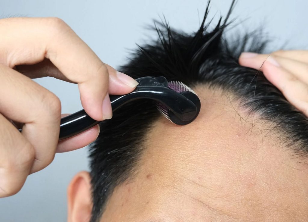 Can a Dermaroller Stimulate Hair Growth?