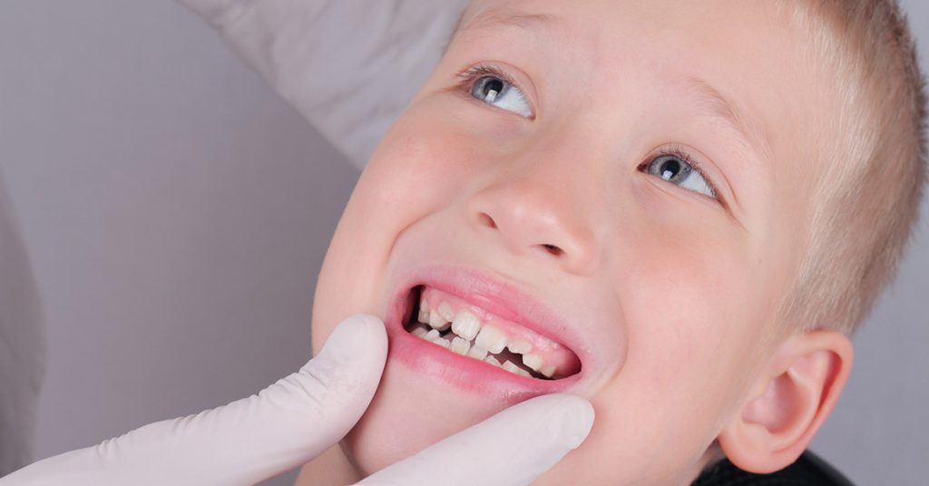 Bite Problems in Orthodontics: Types and Causes